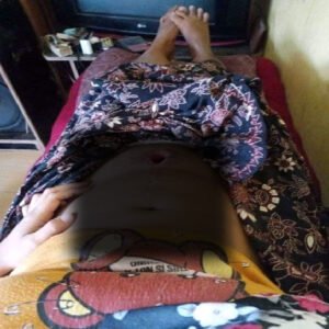 Pasien Perut Berlubang Menderita di Purwakarta, Memohon Bantuan Presiden Dan Menteri Kesehatan