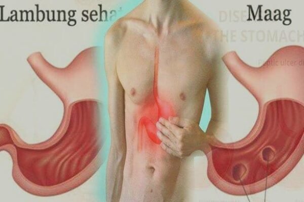 dr. Elisabeth: Penderita Asam Lambung Jangan Berbuka Dengan Teh Hangat