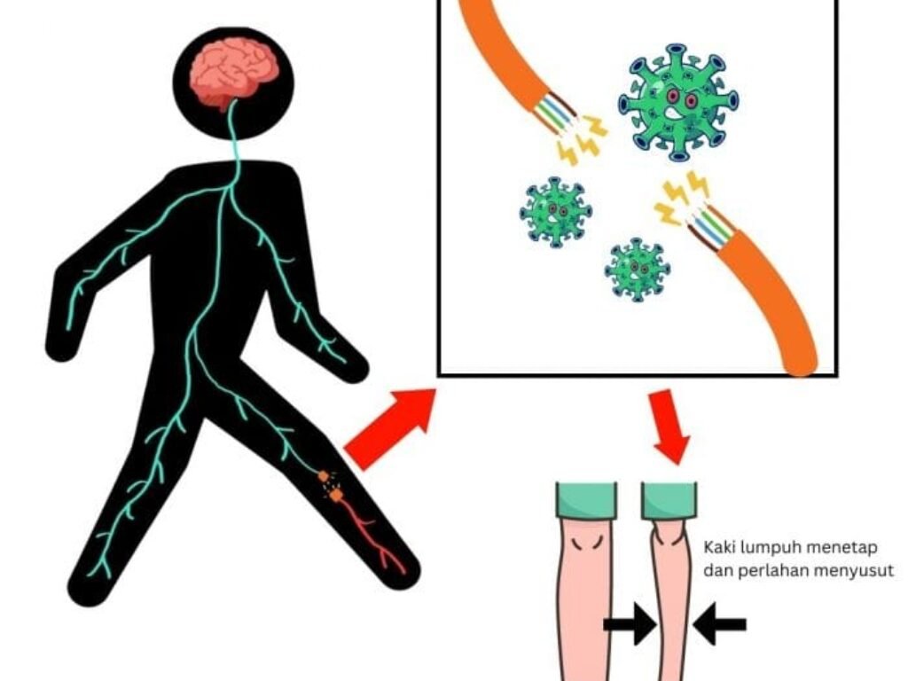 Kejadian luar biasa (KLB) akibat virus Polio Kembali Terjadi, Salah Satunya di Jawa Barat
