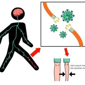 Kejadian luar biasa (KLB) akibat virus Polio Kembali Terjadi, Salah Satunya di Jawa Barat