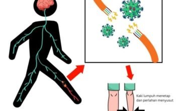 Kejadian luar biasa (KLB) akibat virus Polio Kembali Terjadi, Salah Satunya di Jawa Barat