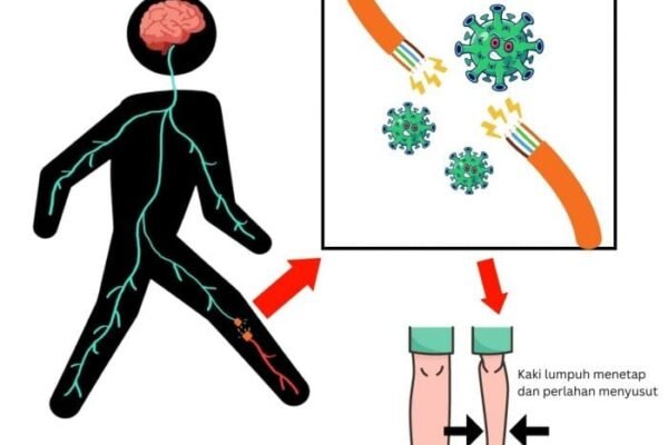 Kejadian luar biasa (KLB) akibat virus Polio Kembali Terjadi, Salah Satunya di Jawa Barat