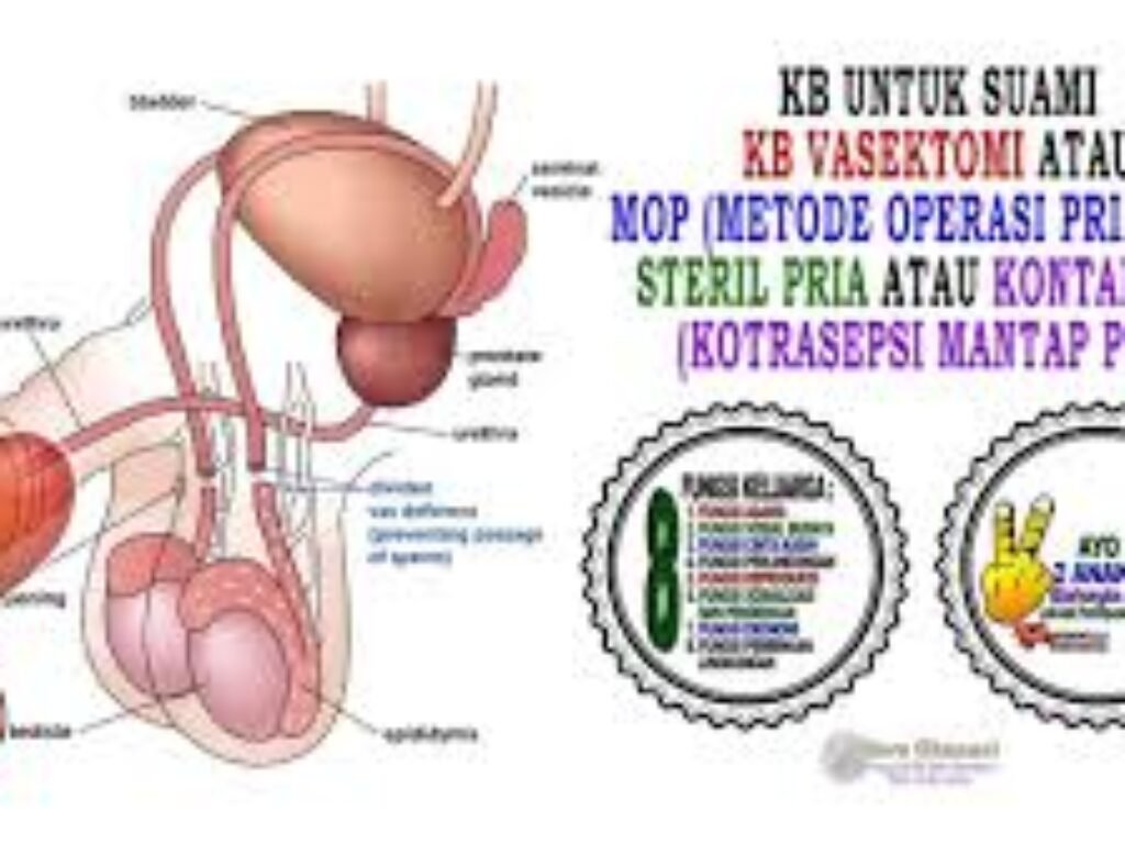Vasektomi Antara Mitos Dan Fakta, Apa Manfaatnya Bagi Pria