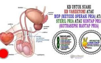 Vasektomi Antara Mitos Dan Fakta, Dan Apa Manfaatnya Bagi Pria