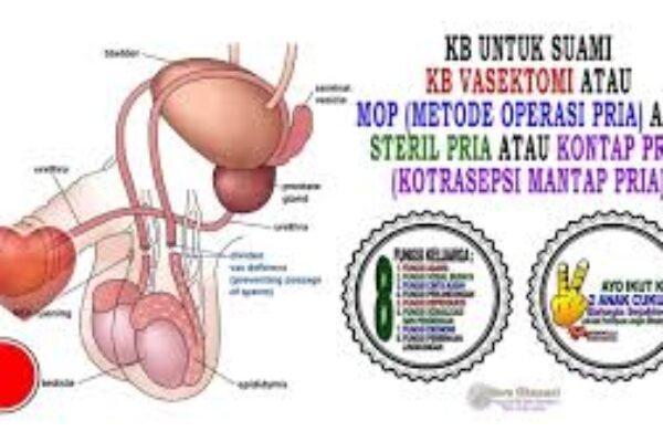 Vasektomi Antara Mitos Dan Fakta, Apa Manfaatnya Bagi Pria