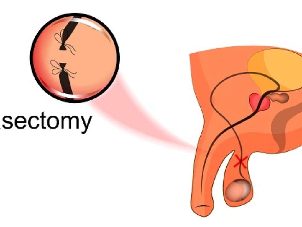 Vasektomi Atau KB Pria, Ini Kekurangan Dan Dampaknya